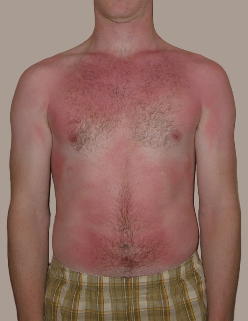 sunburn - front chest